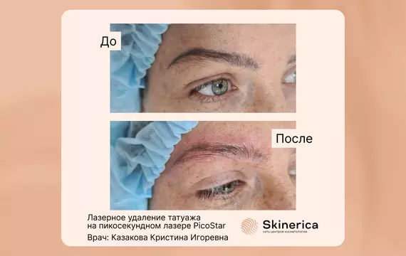 Удаление татуажа пикосекундным лазером PicoStar (Германия)